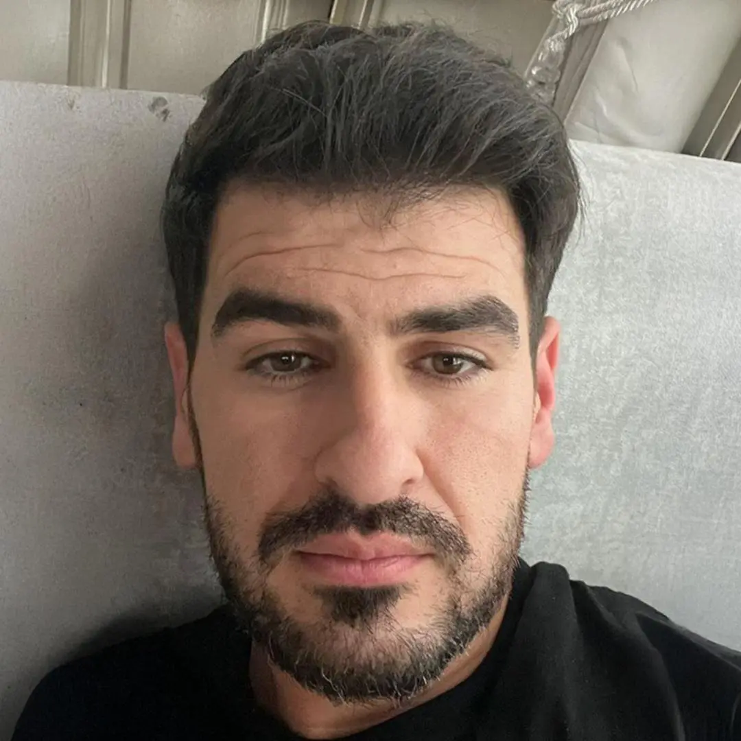 Hair Transplant Abroad in Istanbul