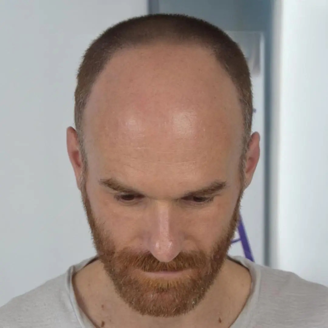 FUE vs DHI Hair Transplant Techniques