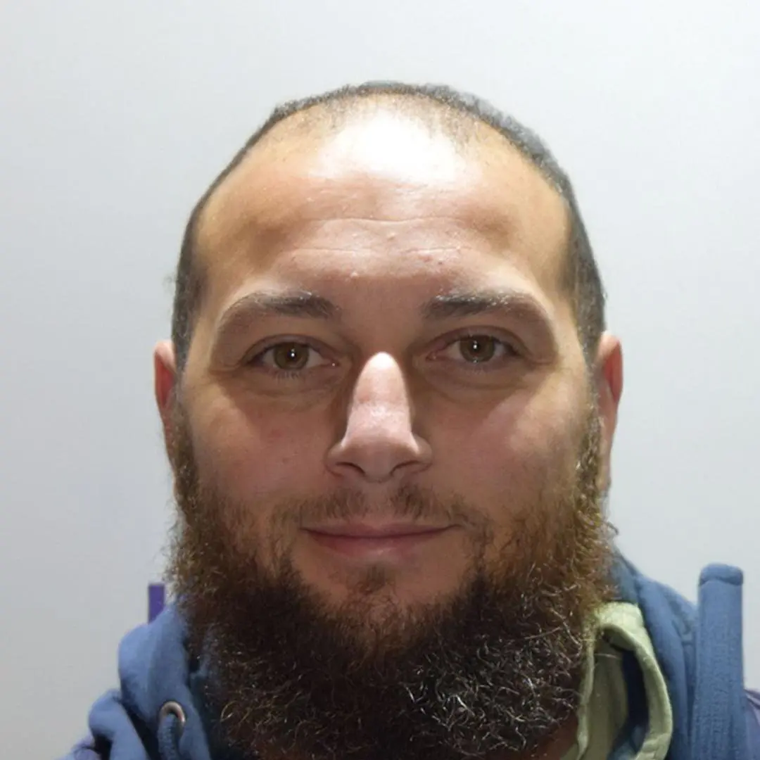 UK vs Turkey Hair Transplant